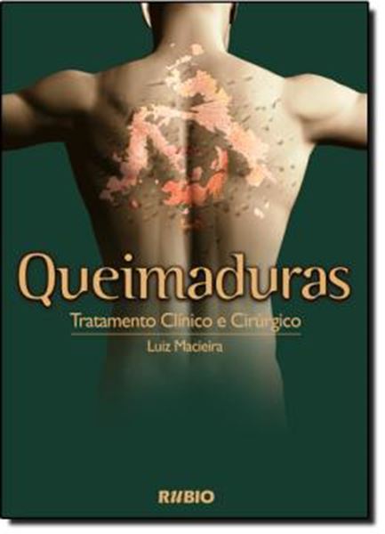 Picture of QUEIMADURAS - TRATAMENTO CLINICO E CIRURGICO