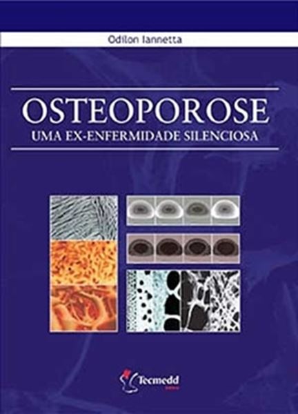 Picture of OSTEOPOROSE
